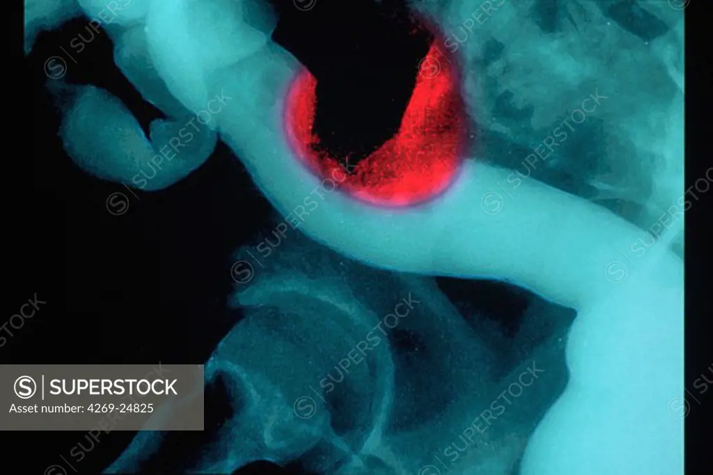 Colon cancer. X-ray of the colon showing cancer of the sigmoid colon (black spot with red circle). Opaque to X-rays barium (barium enema) is given to reveal abnormalities. The irregular filling of the colon with the barium (white) shows the presence of a tumour.