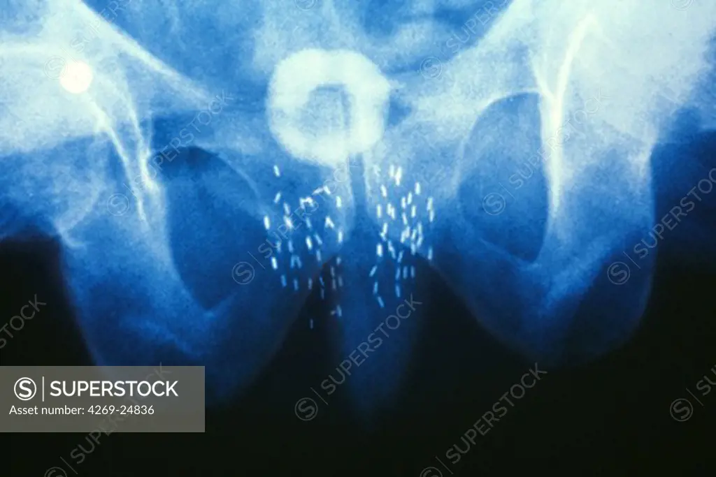 Curietherapy. Pelvis X-ray showing a prostate cancer treated with curietherapy (or brachytherapy), a type of radiotherapy where radioactive sources are inserted into the area to be treated. Here threads of radioactive iridium are implanted into the prostate.