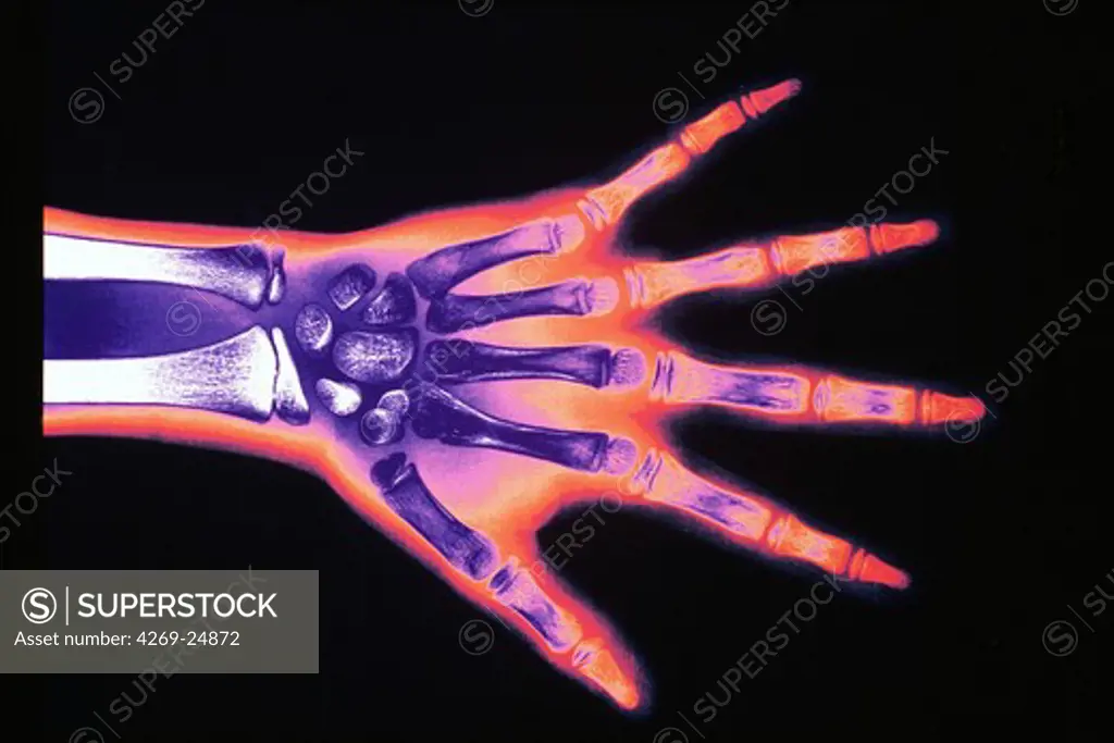 Hand x-ray. X-ray of the hand of a 10 years old child revealing its bone age. The bone age shows the process of ossification (tranformation of cartilage into bone) of specific parts of the skeleton. Compared with chronoligical age, it reveals pathlogies like growth delay.