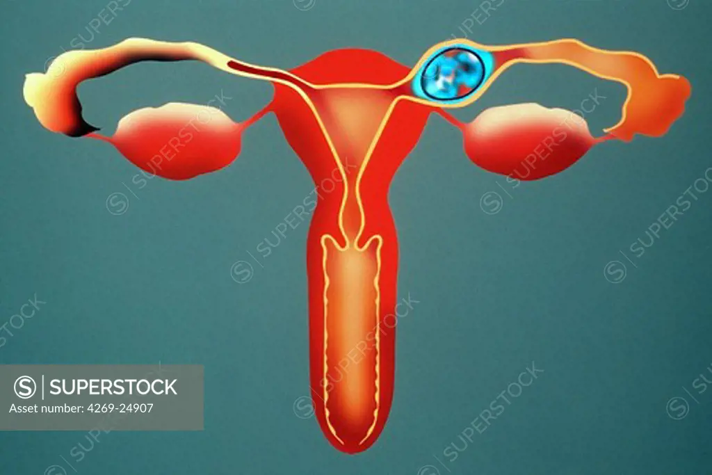 Ectopic pregnancy. Female genitals
