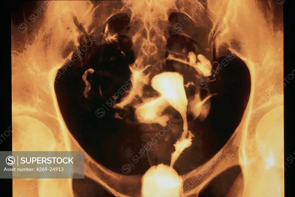 Uterus. Hysterography : X-ray of healthy uterus.