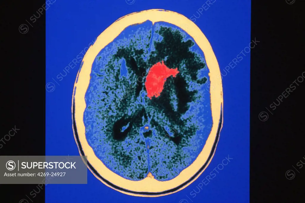 Brain tumor. Axial computed Tomography (CT) scan of the brain showing an astrocytoma, a left frontoparietal malignant tumor (red spot) developped from the astrocytes.