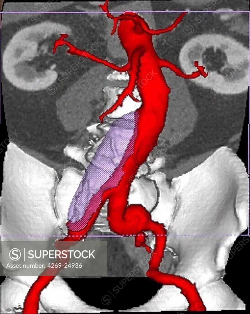 Aortic aneurysm. Three-dimensional computed tomographic (CT) scan reconstruction of aorto-iliac aneurysm.