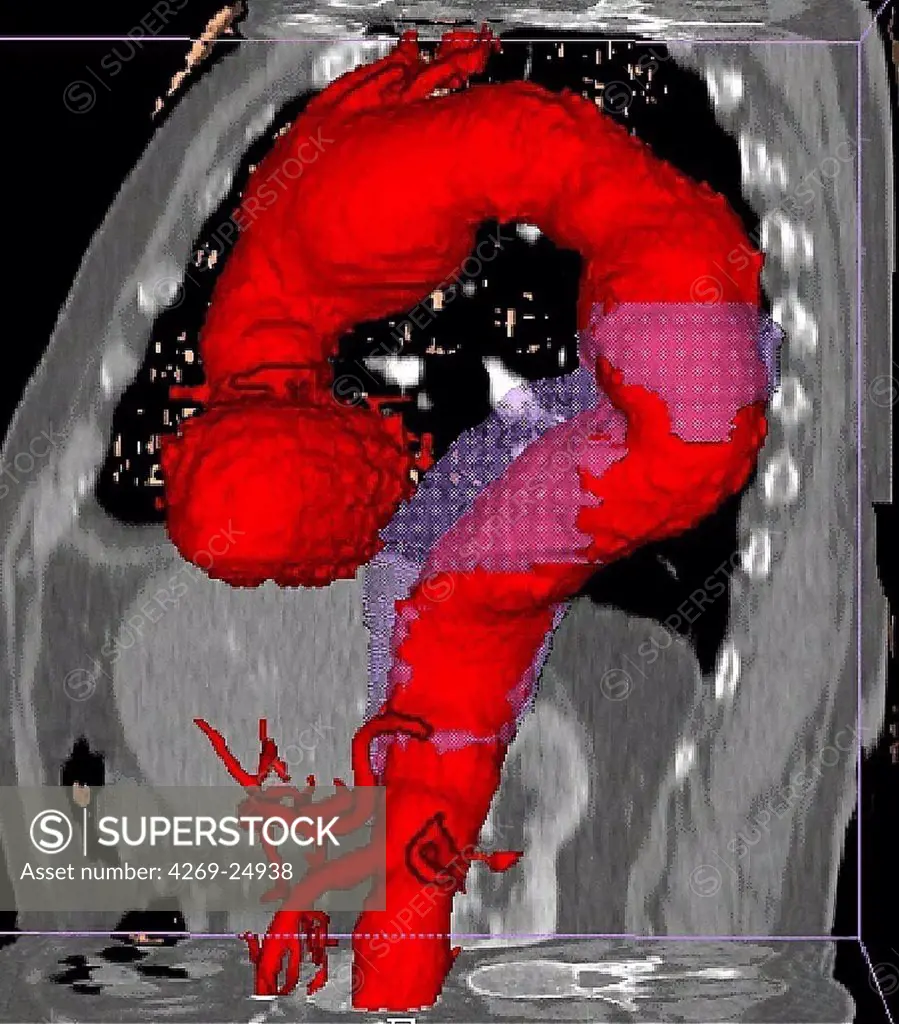 Multiple aortic aneurysm. Three-dimensional computed tomographic (CT) scan reconstruction of multiple aortic aneurysms.