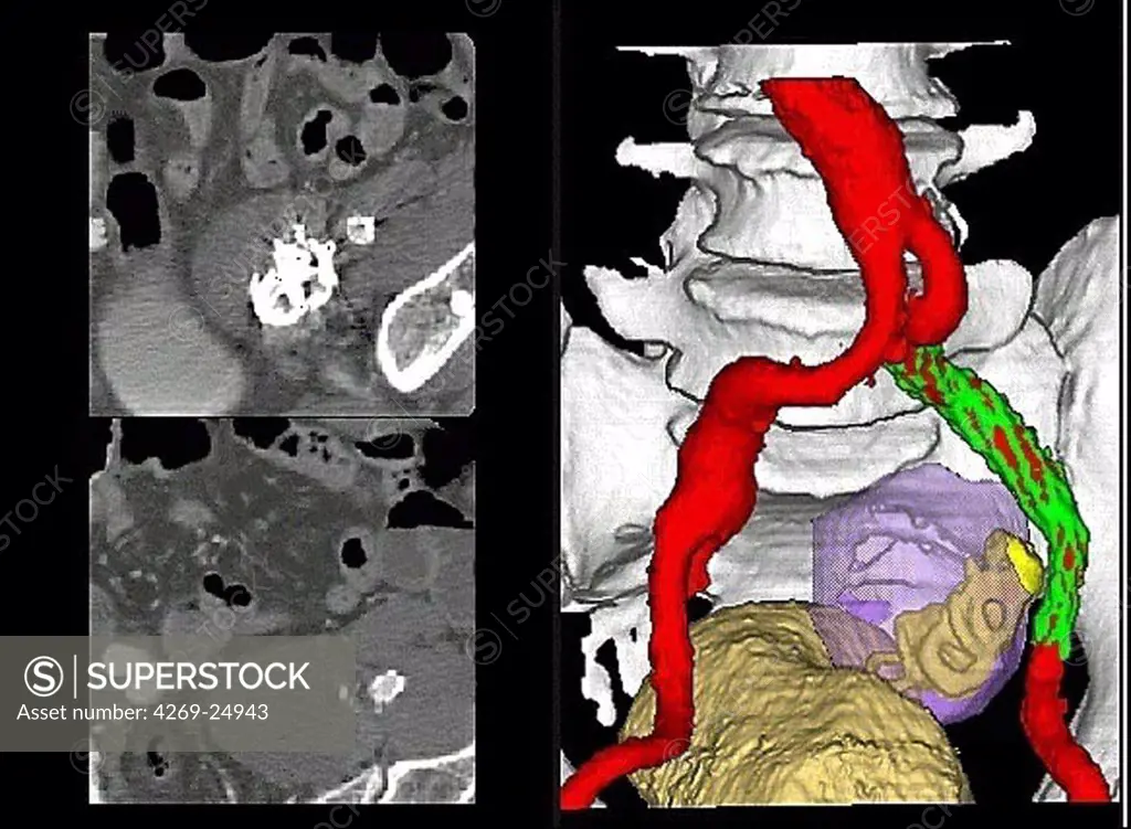 Iliac artery aneurysm. 3D computed tomographic (CT) scan view of internal iliac artery aneurysm treated with a Stent. The aneurysm appears as a swollen bulge (left, in red).
