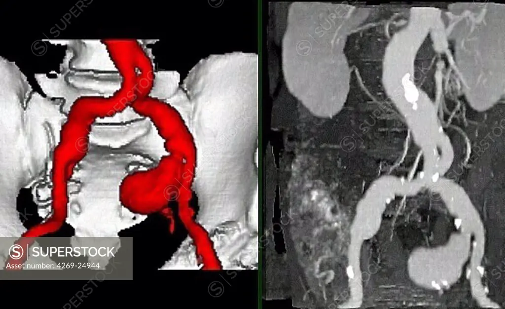 Iliac artery aneurysm. Three-dimensional (left) and plane (right) computed tomographic (CT) scan reconstruction of an internal iliac artery aneurysm. It appears as swollen bulge (red, at right). An aneurysm is a bulge of a vessel due to the dilatation of its wall. A ruptured aneurysm can be fatal.