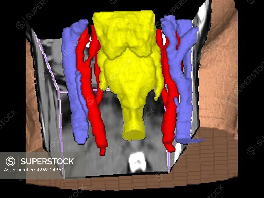 Stenosis. 3D computed tomographic (CT) scan reconstruction of a stenose of the right internal carotid artery. In blue, the carotid veins, in yellow, the respiratory tracts.