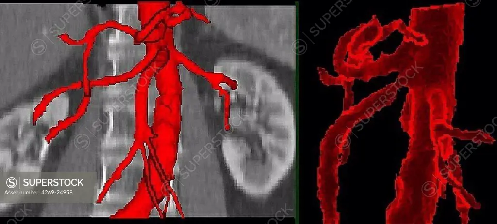 Stenosis. 3D computed tomographic (CT) scan reconstruction of an a stenosis of the superior mesenteric artery.