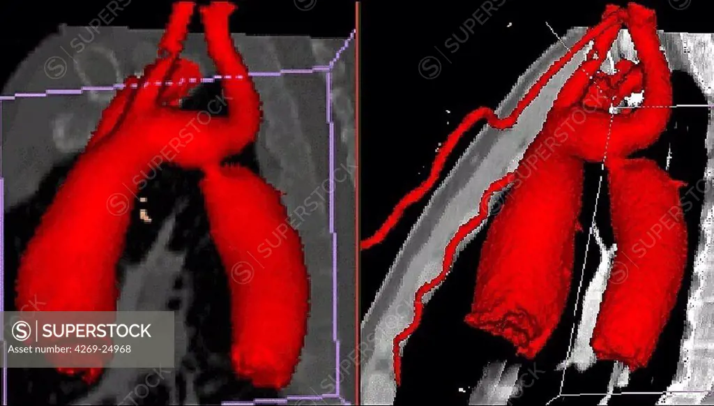 Coarctation of the aorta. 3D computed tomographic (CT) scan reconstruction showing a coarctation of the aorta. It is a malformation of the aorta, often congenital, resulting in a narrowing of the aorta seen here just below the aortic arch.