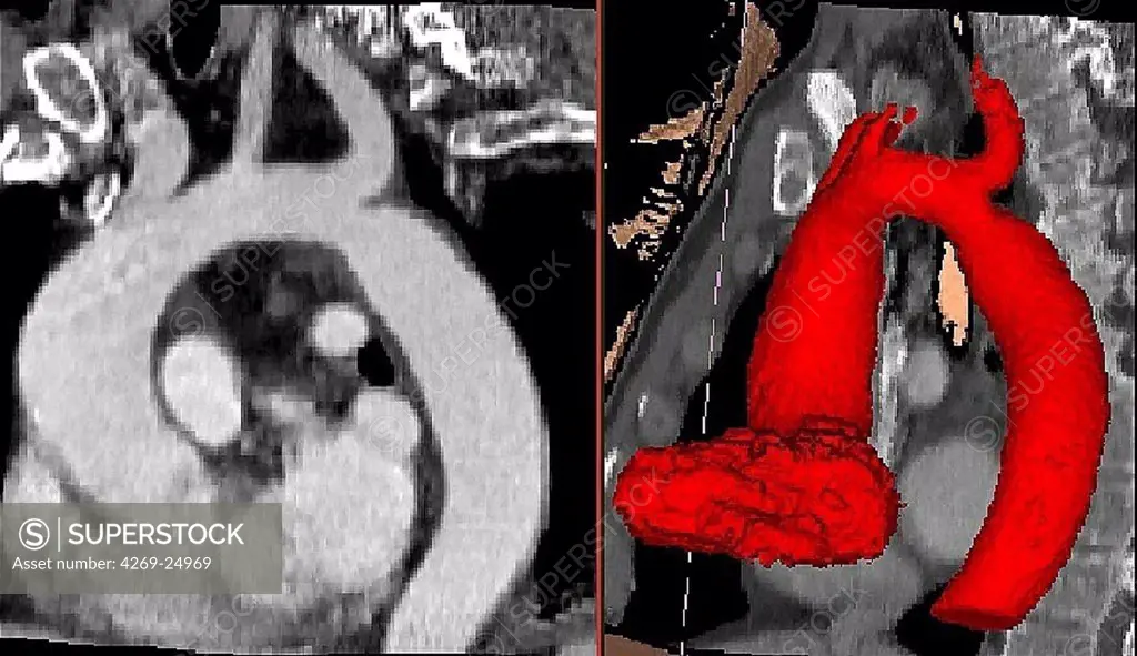 Coarctation of the aorta. 3D computed tomographic (CT) scan reconstruction showing a coarctation of the aorta. It is a malformation of the aorta, often congenital, resulting in a narrowing of the aorta seen here just below the aortic arch.
