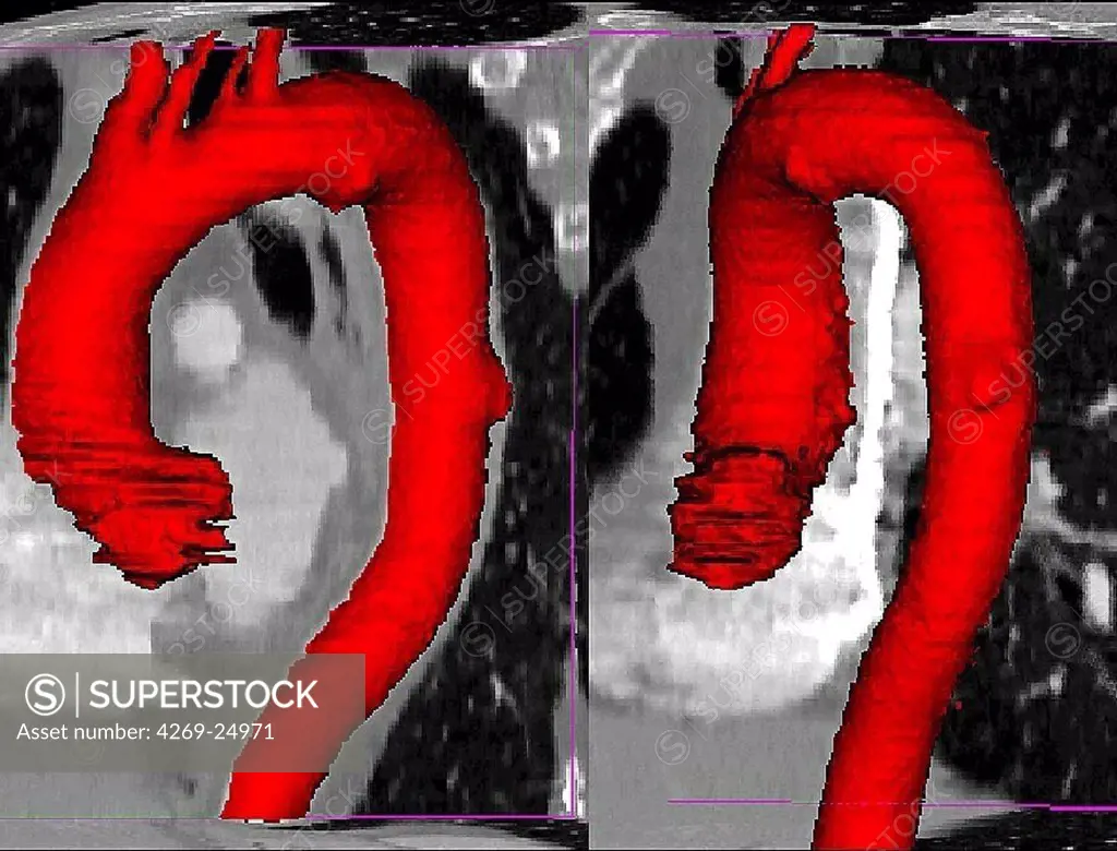 Ulcer of the aorta. 3D computed tomographic (CT) scan reconstruction of the aorta showing an ulceration : excrescence on the right part of the thoracic aorta.