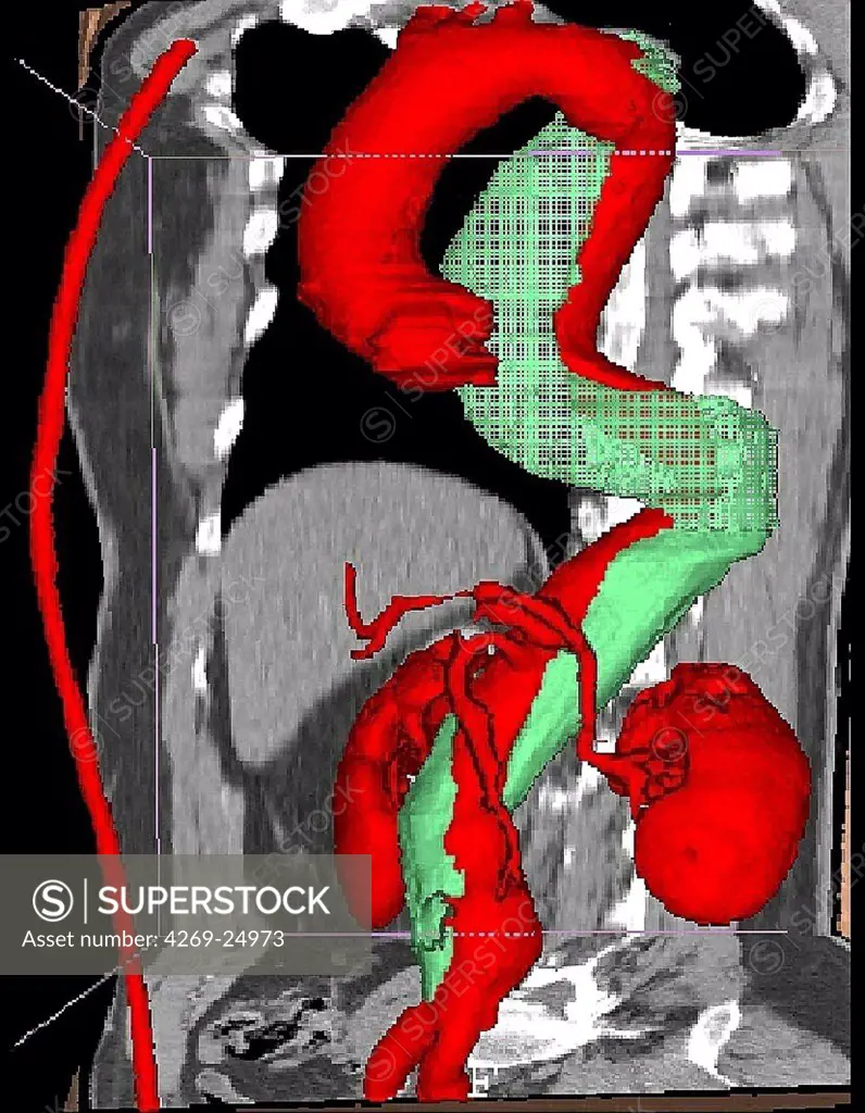 Dissecting aneurysm of the aorta and its complications. 3D computed tomographic (CT) scan reconstruction of a dissecting aneurysm of the aorta (left side view).