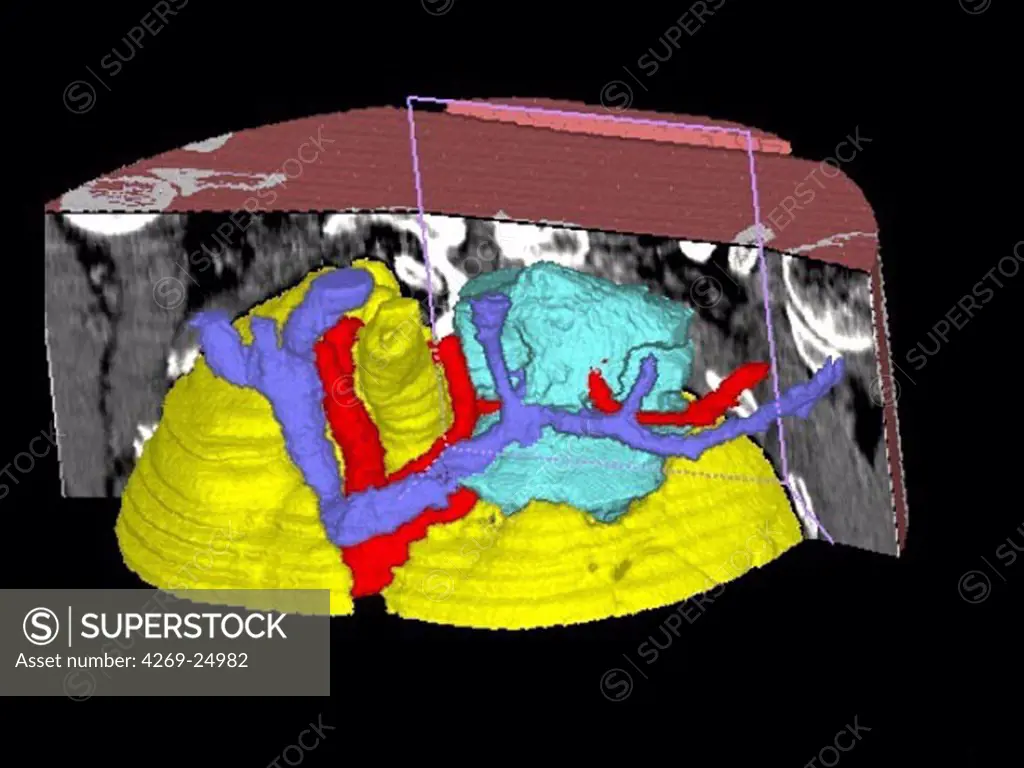 Lung cancer. Three-dimensional computed tomography (CT) scan of upper thorax showing a Pancoast's syndrome associated with a lung cancer. In purple, the subclavian vein and branches, in red the sub-clavian artery. The tumor of the superior lobe of the left lung (blue) pushes strognly the lungs (yellow).