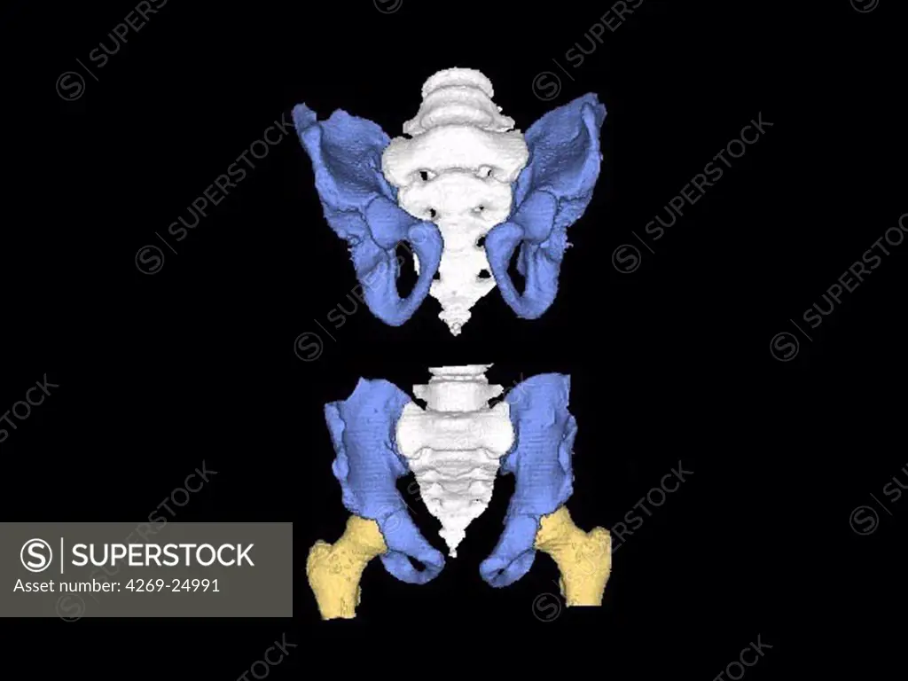 Hip malformation. 3D computed tomographic (CT) scan reconstruction of the bassin showing malformation of the hip, where the left iliac wing (hip bone, in blue) is atrophied.