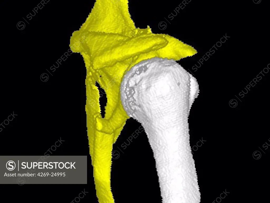Shoulder blade. 3D computed tomographic (CT) scan reconstruction of the shoulder showing a displaced transverse scapula fracture (yellow). In white, the humerus.
