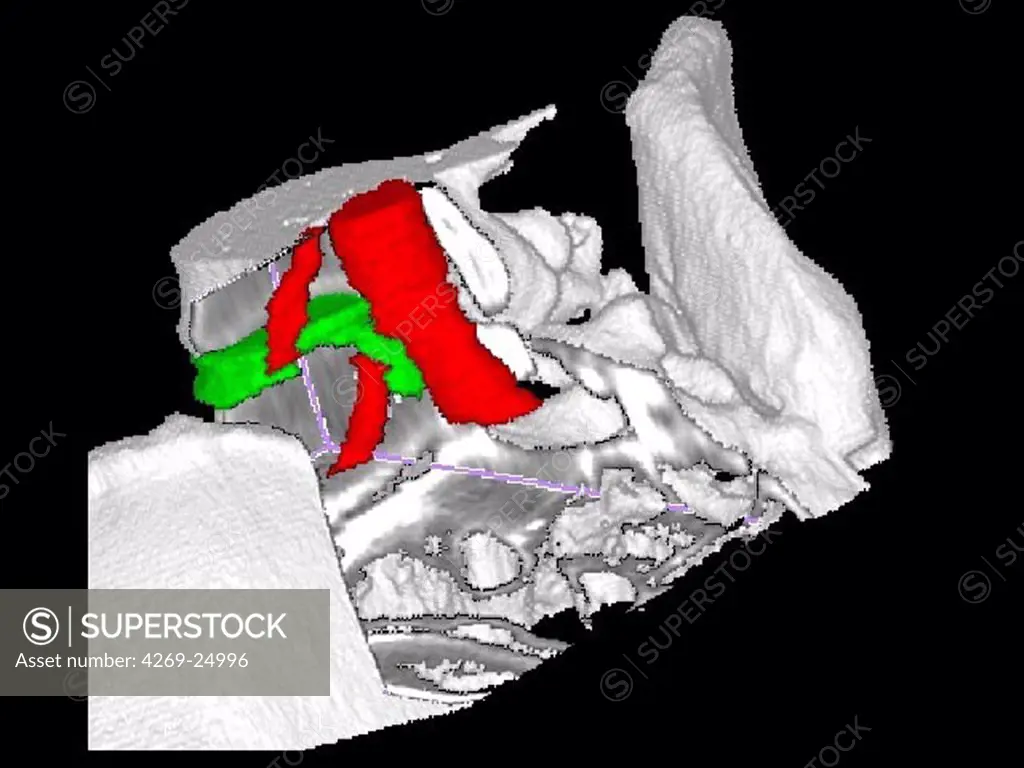 Slipped disc. 3D computed tomographic (CT) scan reconstruction of the lower rachis showing a slipped disc. The vertebral disk (green), crusched between the lumbar vertebras L5 and L4, pushes against the nerve (red) and cause a lombosciatica.
