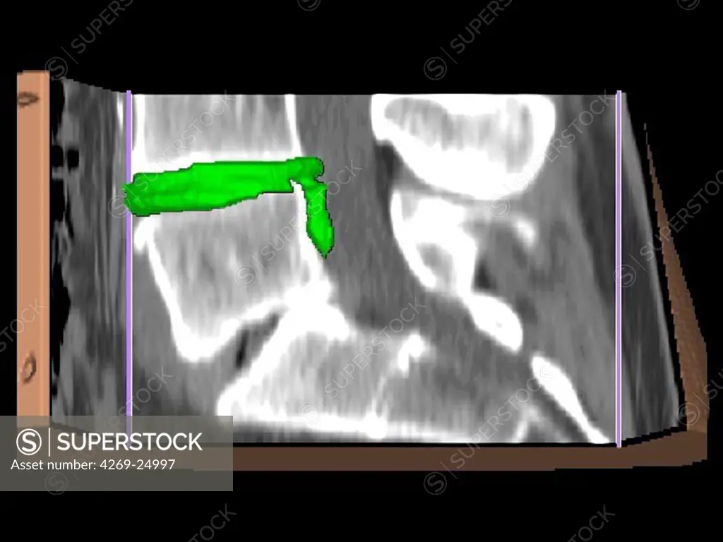 Slipped disc. 3D computed tomographic (CT) scan reconstruction of the lower rachis showing a slipped disc. The vertebral disk (green) is crusched between the lumbar vertebras L5 and L4, and cause a lombosciatica.