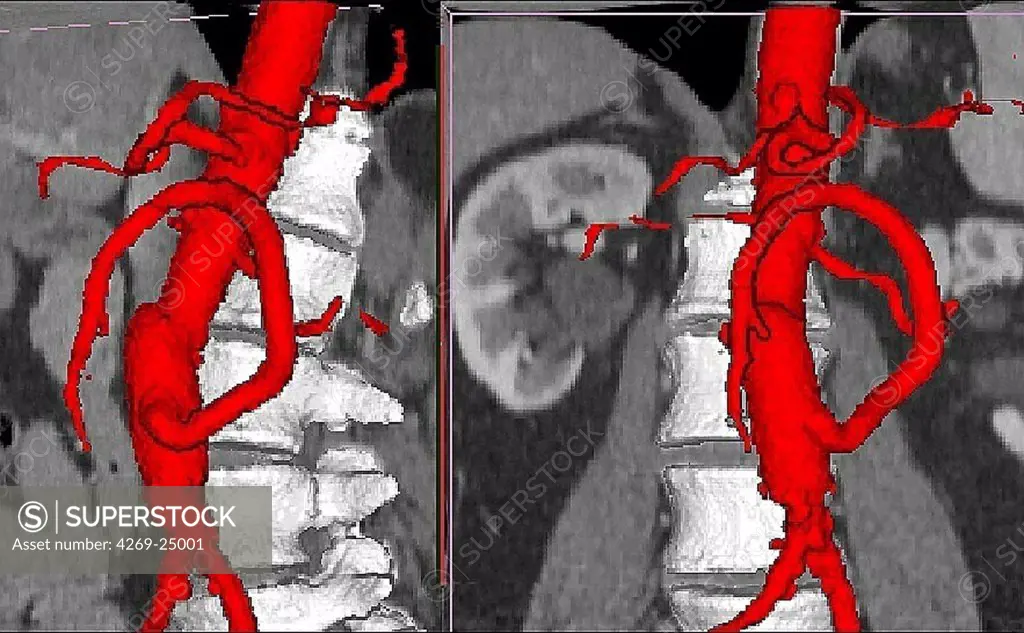 Bypass. 3D computed tomographic (CT) scan reconstruction of superior aorto-mesenteric bypass.