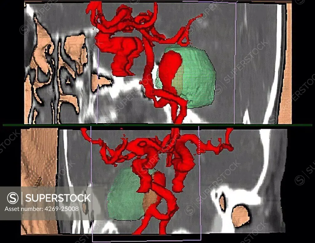Intracranial aneurysm. Three-dimensional computed tomographic (CT) scan reconstruction of an intracranial aneurysm located on the basilar artery (red ballon shaped swelling) partially thrombosed (green).