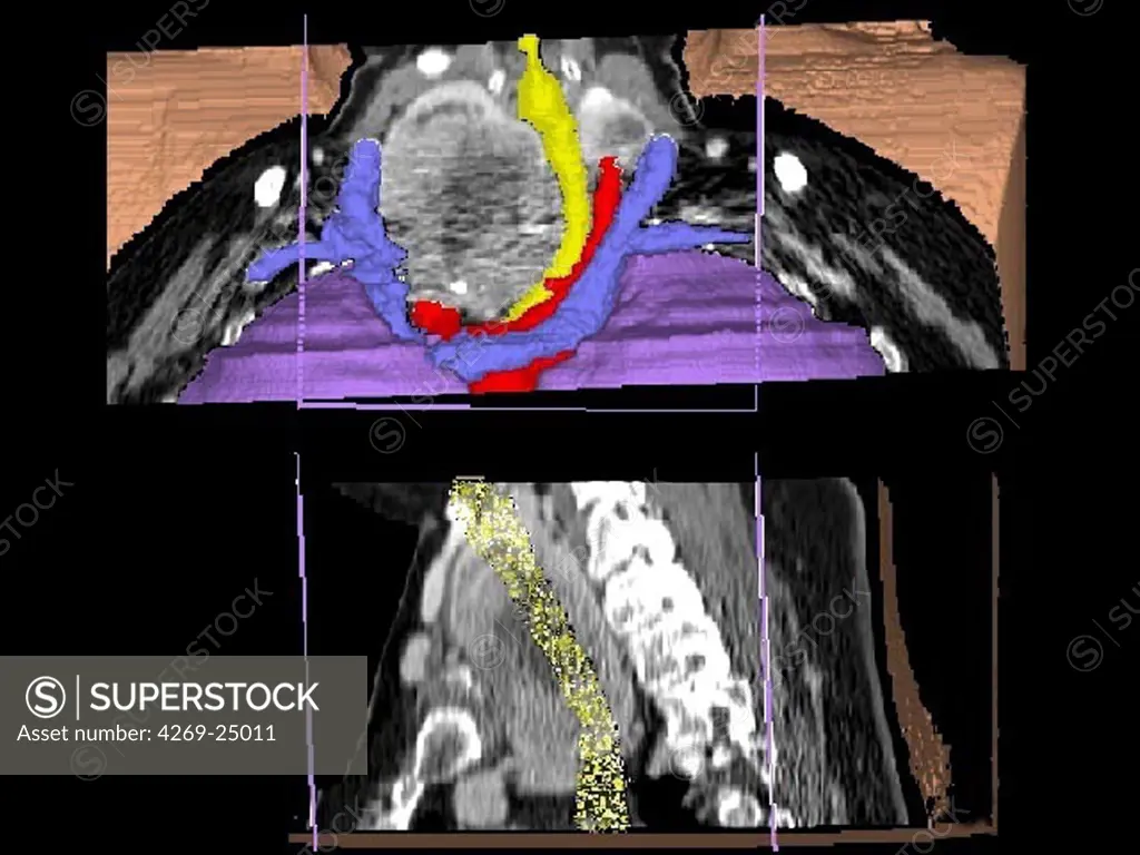 Goitre. 3D computed tomographic (CT) scan reconstruction of the throat showing a voluminous thyroid goitre (8cm x 6cm x 5cm) causing a compresion of the veins (blue) and arteries (red ) of the neck.