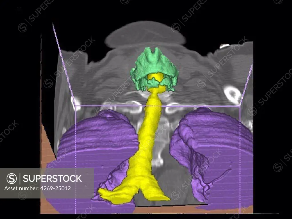 Goitre. 3D computed tomographic (CT) scan reconstruction of the upper chest showing a voluminous thyroid goitre (8cm x 6cm x 5cm) causing a compresion of the venous structures.