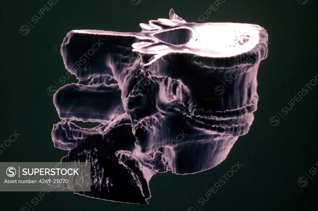 Vertebral discs hernia. Three-dimensional computed tomographic (CT) scan reconstruction of the rachis showing a slipped disc in L4-L5. Slipped disc occurs when an intervertebral disc weakens or ruptures, allowing its pulpy content to bulge out and press against the spinal cord.