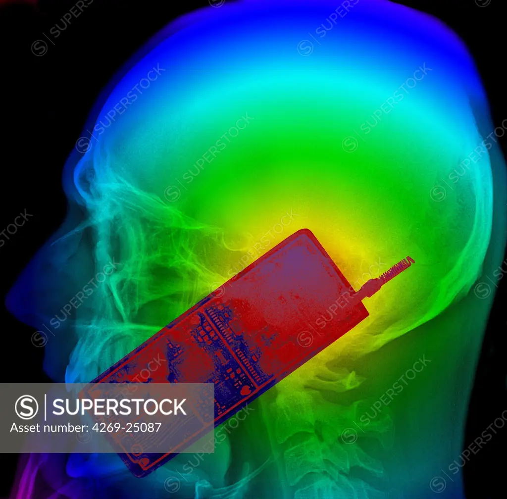 Mobile phone and microwaves. Colored X-ray showing the head of a man using a mobile phone. The use of mobile phone generates microwaves that penetrate in the brain. This exposure may cause cancer and changes in hormone levels.