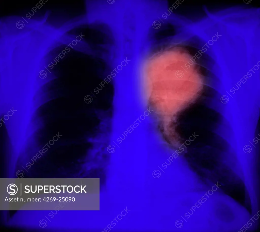 Primary lung cancer. Colored chest x-ray showing primary lung cancer. The malignant tumour is the ballon-shaped carcinoma (pink). Several types of primary lung cancers can occur : small cells carcinoma, large cells carcinoma and adenocarcinoma.