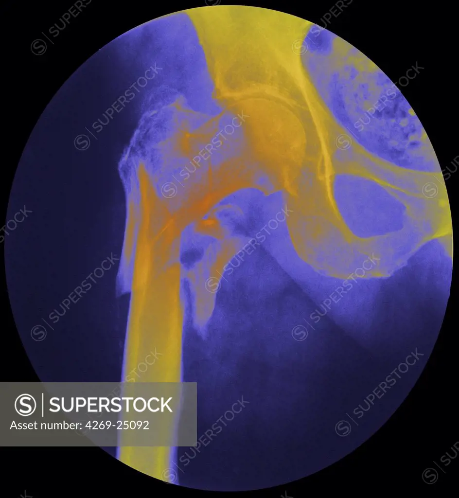 Fractured femur neck. Colored X-ray of the right hip of a patient, showing a fracture of the neck of the femur (yellow). The femoral head (round, center left) has separated from the femoral shaft (lower left) due to this fracture. Osteoporosis can cause this type of fracture.