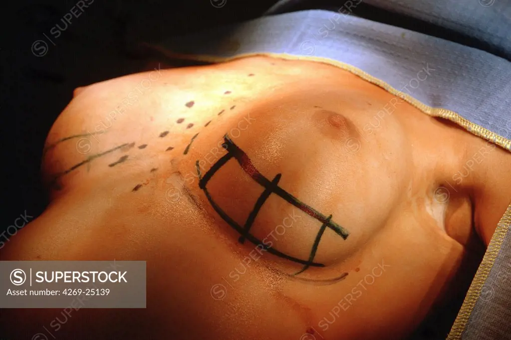 Plastic surgery. Placing silicone breast prosthesis
