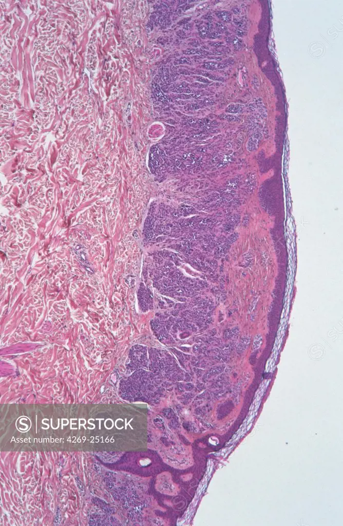Histology. Benign cutaneous naevus Light microscopy