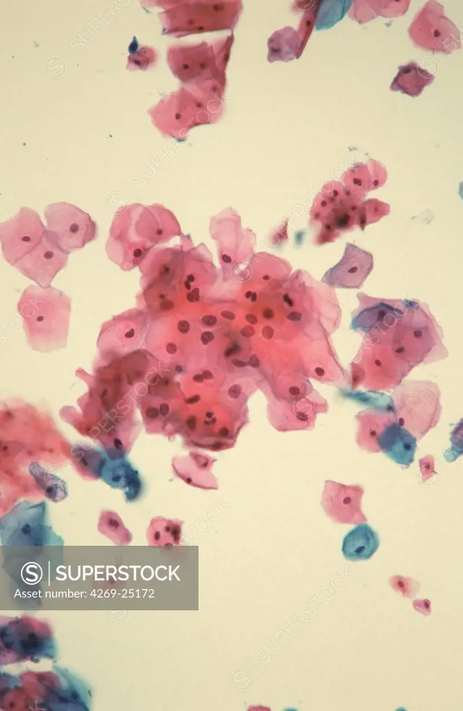 HPV infection. Light microscopy of cervical smear showing epithelial cells infected with the human papilloma virus (HPV). HPV causes genital warts by parakeratosis and is implicated in the development of cervical cancer. Infected cells show anomalies  in their shape and structure.