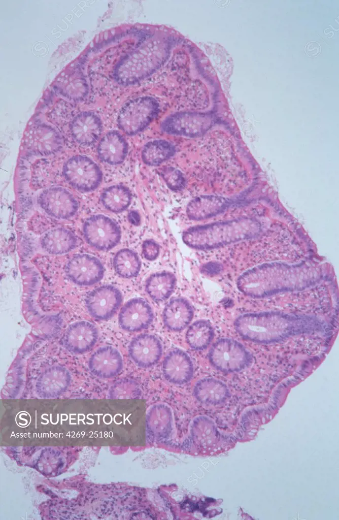 Histology. Colon polyadenoma Light microscopy