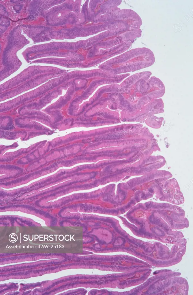 Histology. Surface of colon precancerous villous tumor Light microscopy