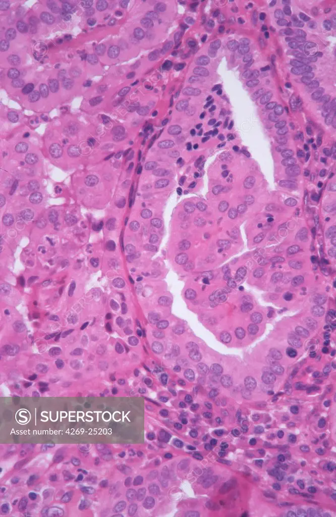 Cancerous cells of endometrium. Light microscopy