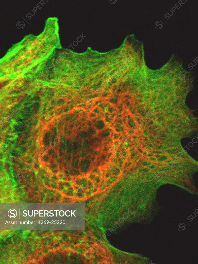 Breast tumour cell. Elements of the mitosis of a breast tumour cell Green