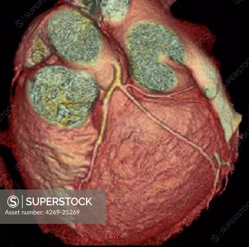 Heart and coronary arteries. 3D computed tomographic (CT) scan reconstruction of a normal heart seen from above, and the left coronary arteries leaving from the base of the aortic arch.