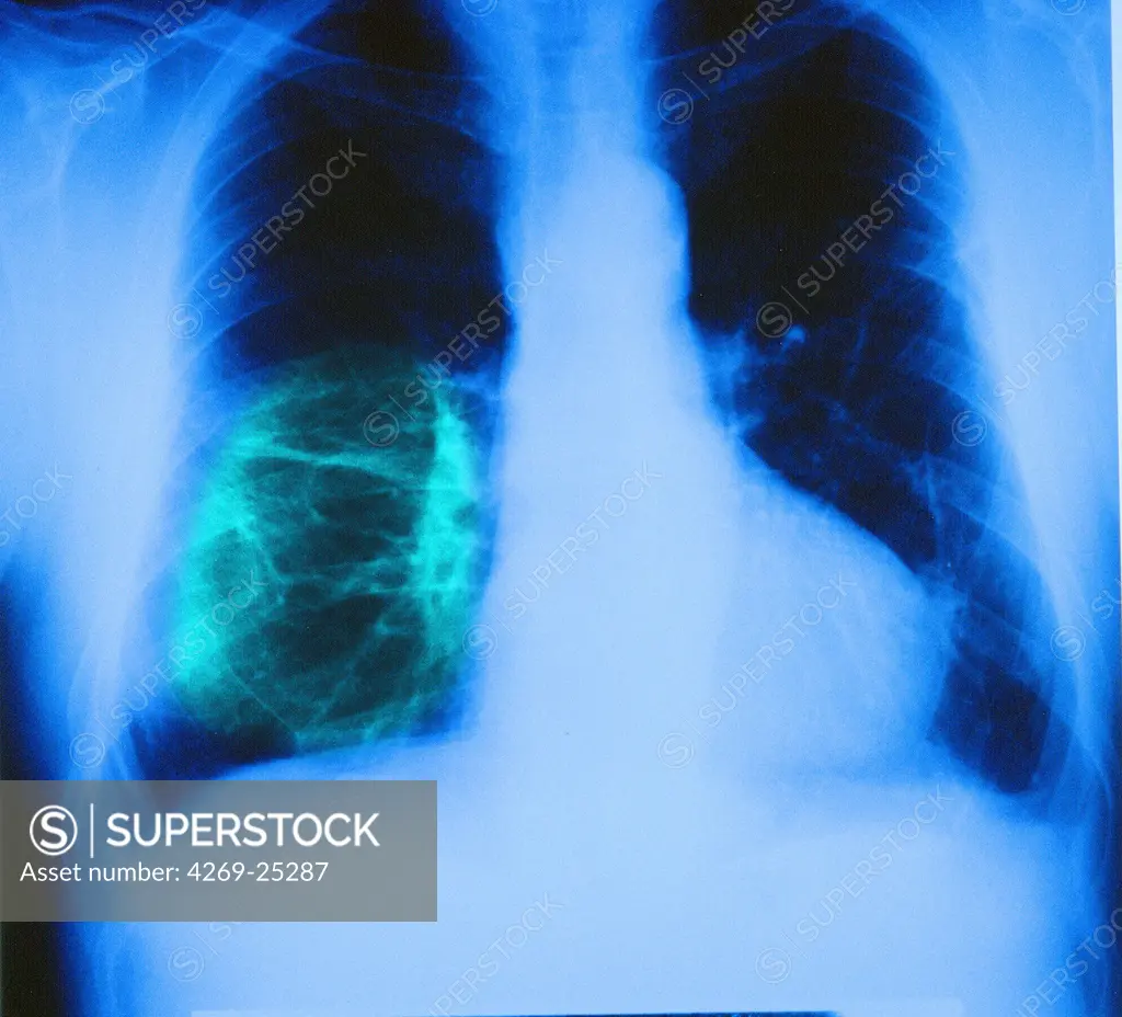 Asbestosis. Color enhanced chest x-ray showing asbestosis, a kind of pneumoconiosis caused by the inhalation of asbestos particules from the air that have damaged the lung tissus (white fibrous masses) and can lead to breathing problems and heart failure.