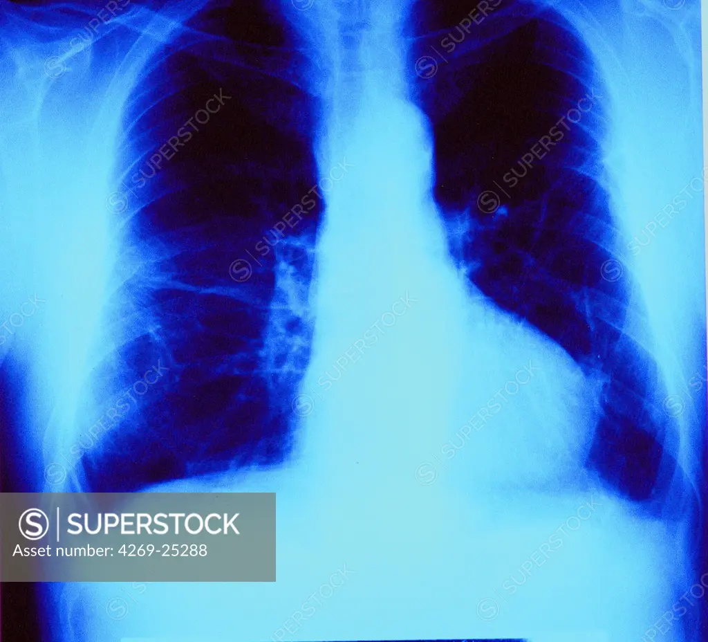 Asbestosis. Color enhanced chest x-ray showing asbestosis, a kind of pneumoconiosis caused by the inhalation of asbestos particules from the air that have damaged the lung tissus (white fibrous masses) and can lead to breathing problems and heart failure.