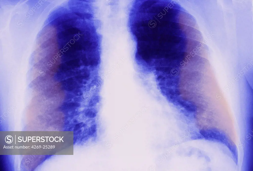 Pulmonary fibrosis. Coloured X-ray of the chest of a patient with pulmonary fibrosis, or interstitial lung disease. Pulmonary fibrosis is the developement of fibrous scar tissue (white) between the alveoli of the lungs. It results in loss of lung volume and breathlessness.