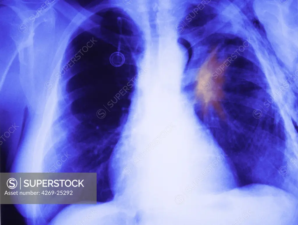 Emphysema. Colored x-ray showing emphysema. Emphysema is the over-inflation of alveoli or air sacs in the lungs, resulting from the breakdown of walls of the alveoli. This causes a decrease in respiratory function and sometimes breathlessness.
