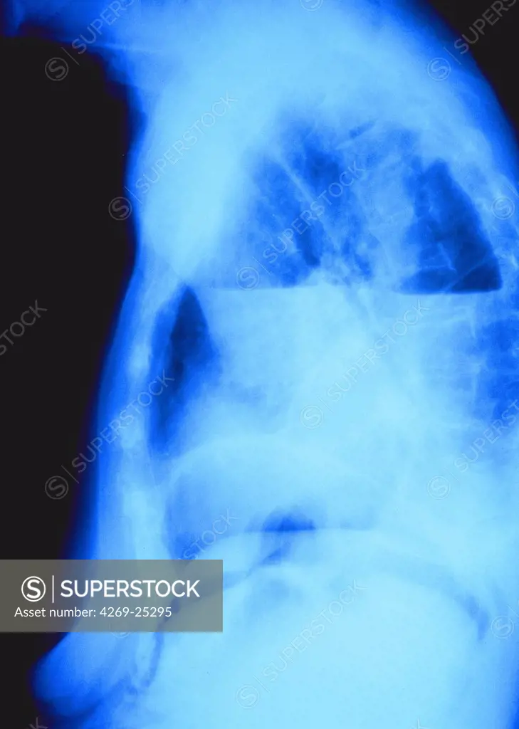Pleurisy. Side view chest x-ray showing pleurisy (white), the inflammation of the pleura or lining of the lungs with subsequent pain.
