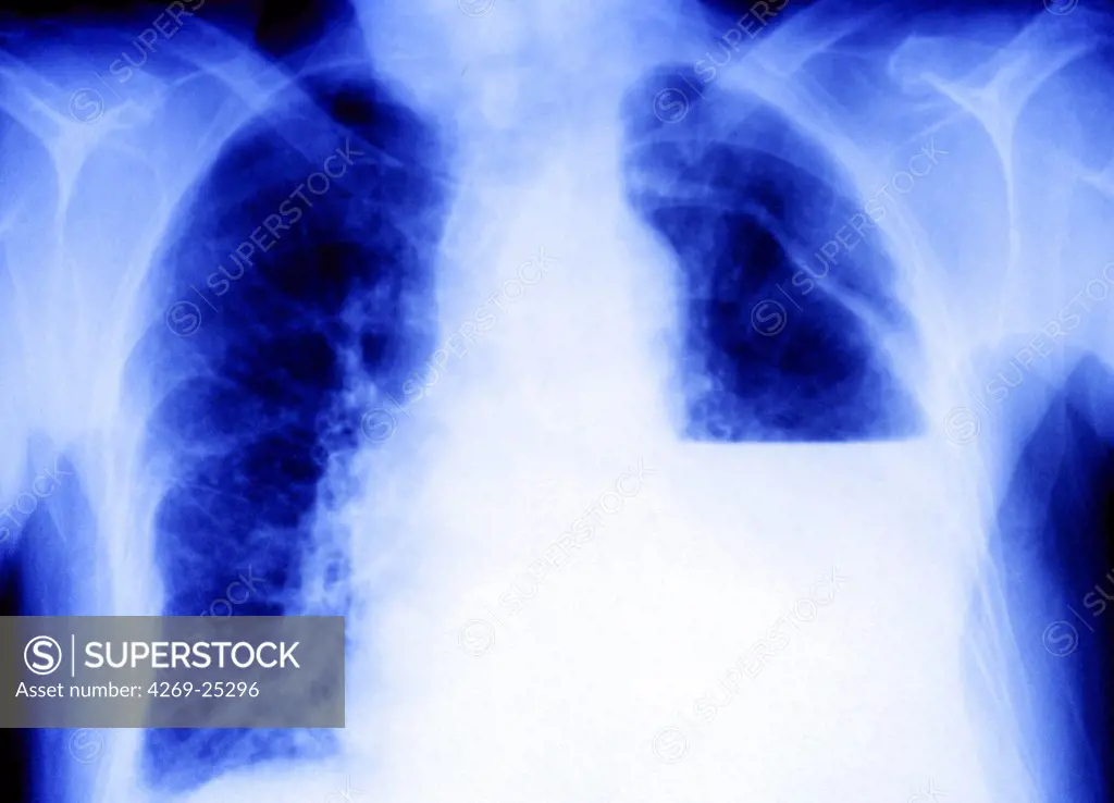 Pleurisy. Front view chest x-ray showing pleurisy (white), the inflammation of the pleura or lining of the lungs.
