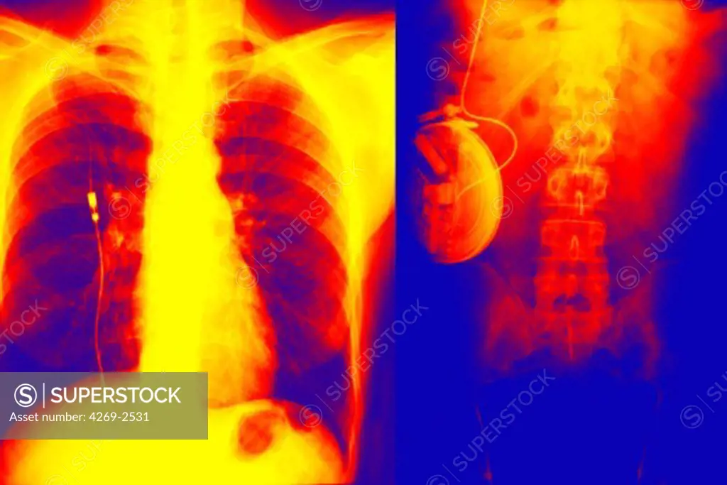 Colored X-ray showing an artificial implanted pancreas, a combination of a sensor that measures blood glucose level implanted in the superior vena cava (left), connected to an implanted insulin pump (right). The insuline is released automatically according the needs of the patient.
