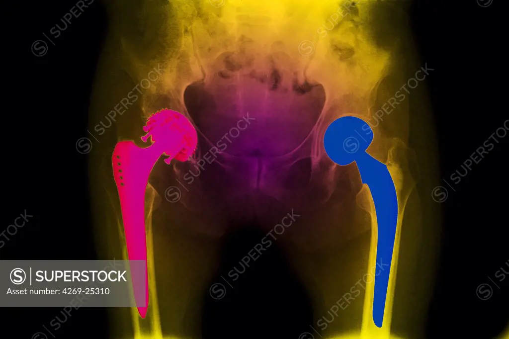 Prosthetic hip. X-ray of a double prosthetic hip showing the shaft of steel inserted into the femur with the artificial ball articulating with the bone socket of the pelvis.
