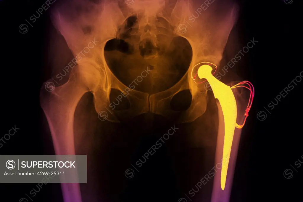 Prosthetic hip. X-ray of prosthetic hip showing the shaft of steel inserted into the femur (yellow), with the artificial ball articulating with the bone socket of the pelvis.