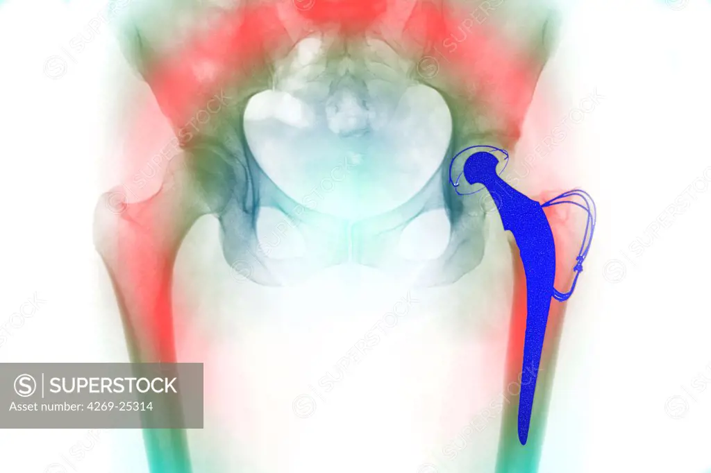 Prosthetic hip. X-ray of prosthetic hip showing the shaft of steel inserted into the femur (blue), with the artificial ball articulating with the bone socket of the pelvis.
