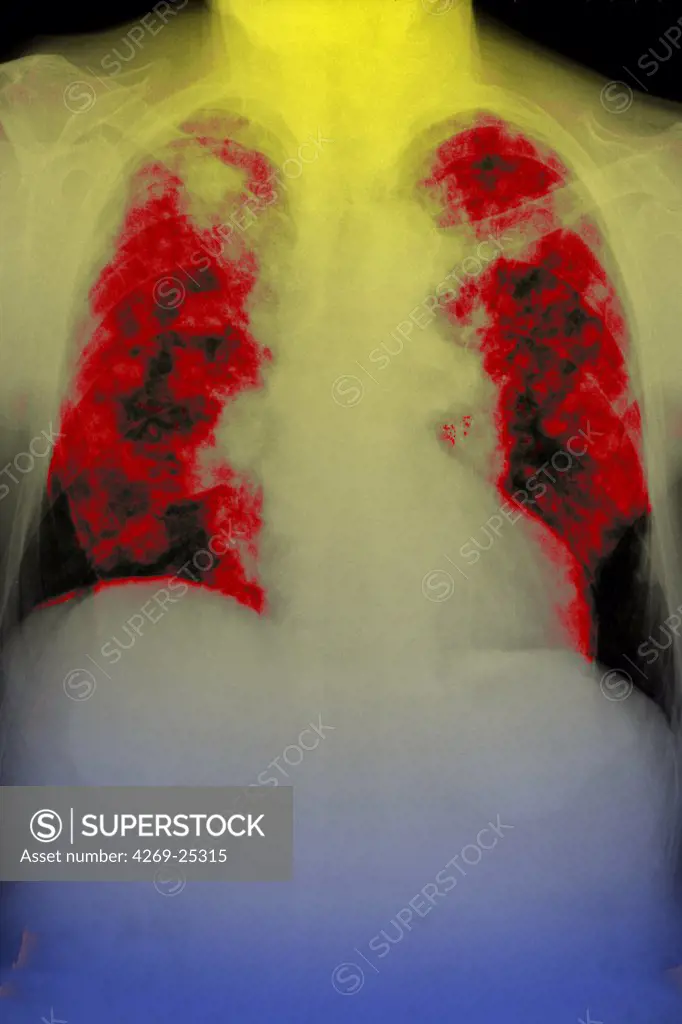 Pulmonary metastasis. Colored X-ray of lungs (red) showing a secondary cancer. The metastasis are seen as patchy black spots.