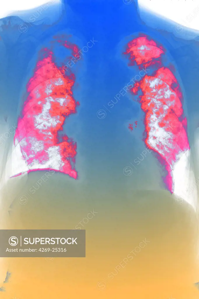 Pulmonary metastasis. Colored X-ray of lungs (pink) showing a secondary cancer. The metastasis are seen as patchy white spots.
