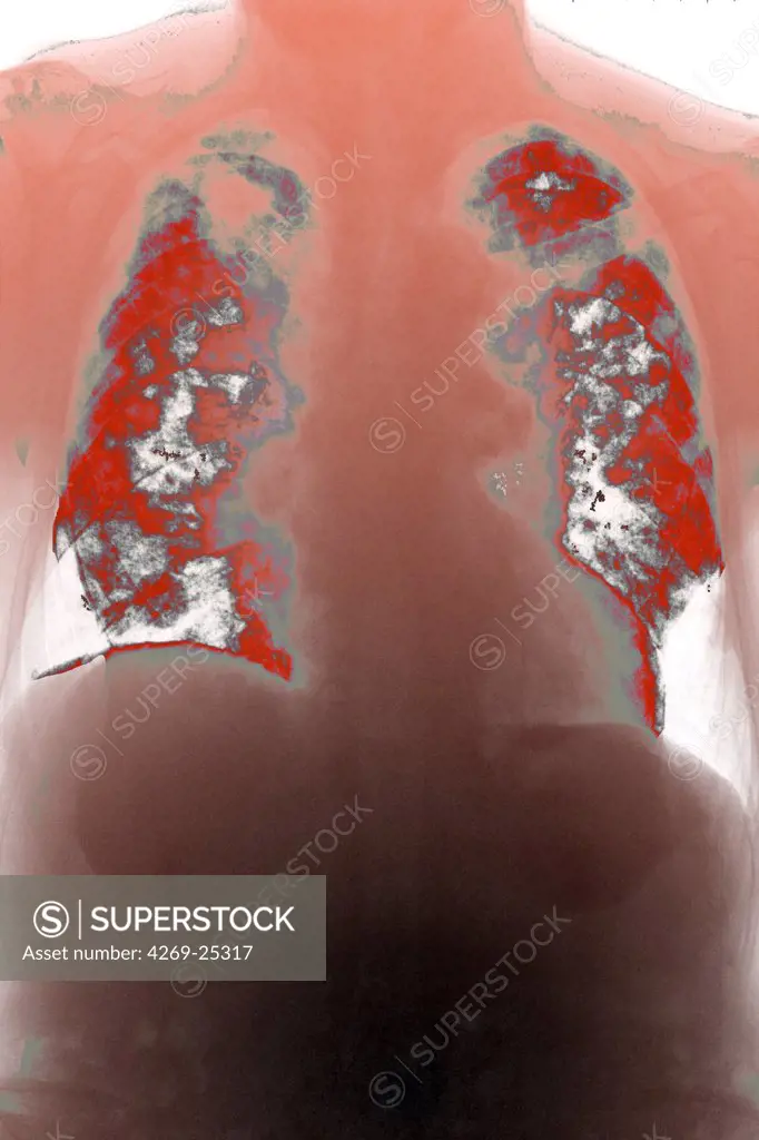 Pulmonary metastasis. Colored X-ray of lungs (red) showing a secondary cancer. The metastasis are seen as patchy white spots.